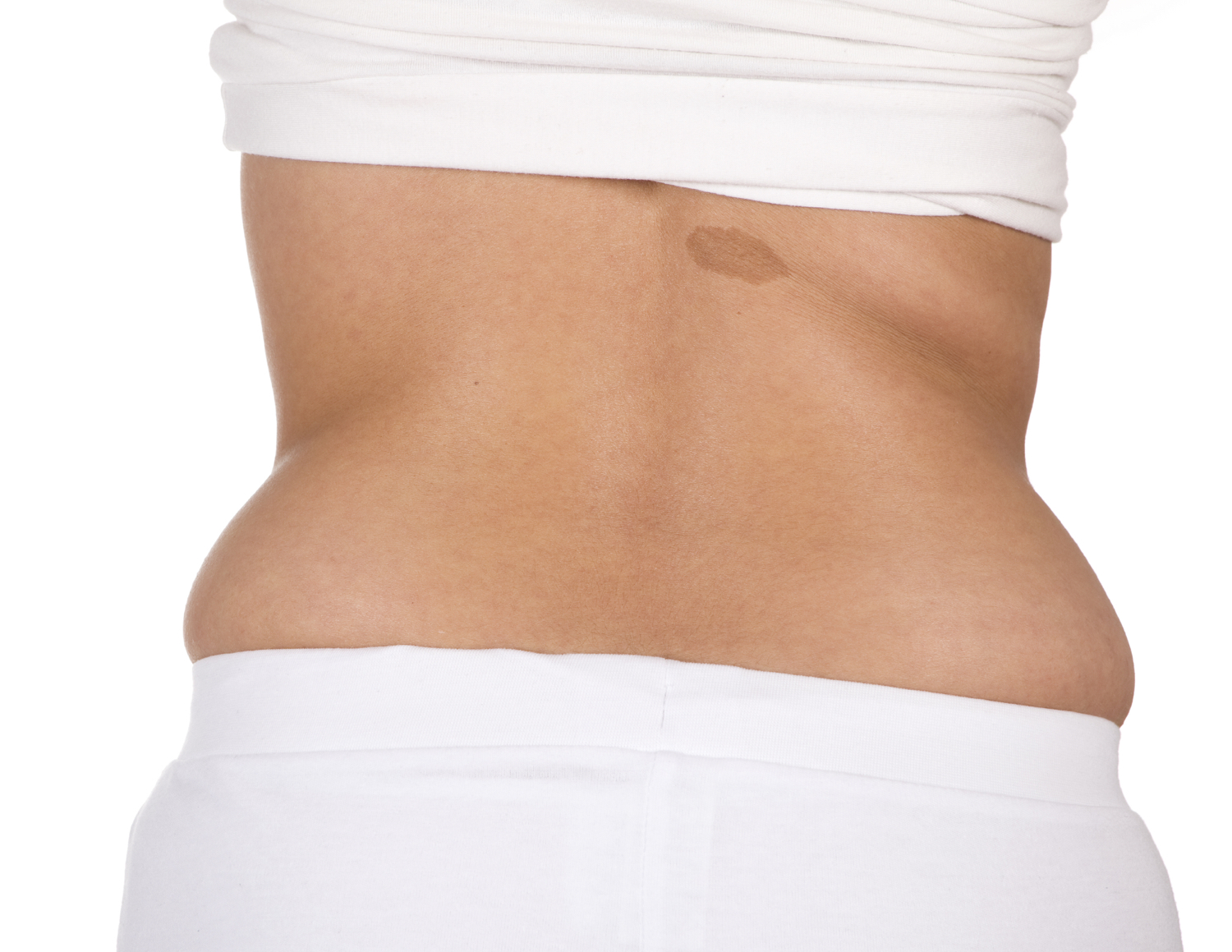 Back Fat | Humphrey & Beleznay Cosmetic Dermatology